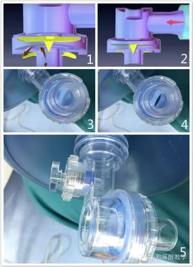 麻醉器是什么【麻醉兵器库】——简易呼吸器之“那些年我们捏过的皮球”_https://www.jmylbn.com_新闻资讯_第5张