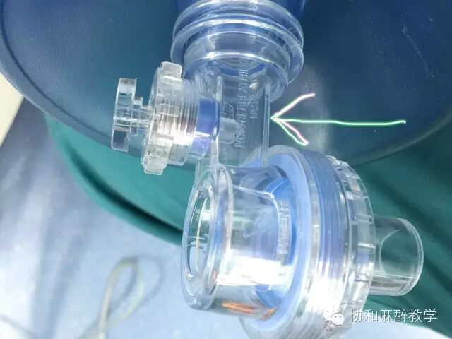 麻醉器是什么【麻醉兵器库】——简易呼吸器之“那些年我们捏过的皮球”_https://www.jmylbn.com_新闻资讯_第7张