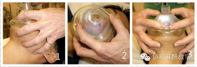 麻醉器是什么【麻醉兵器库】——简易呼吸器之“那些年我们捏过的皮球”_https://www.jmylbn.com_新闻资讯_第8张