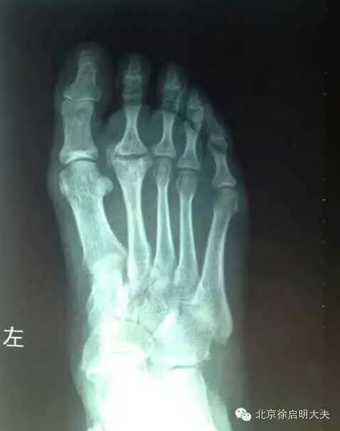 北京徐启明大夫:从一个普通的足趾痛折射骨科疾病的常见诊疗.