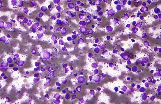 在显微镜下它长这个样子:弥漫大b细胞淋巴瘤活检标本 梁医生vs淋巴瘤