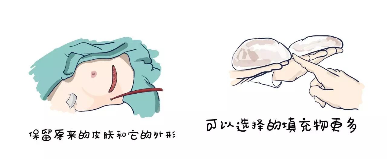 乳腺癌患者也要挺挺的做女人