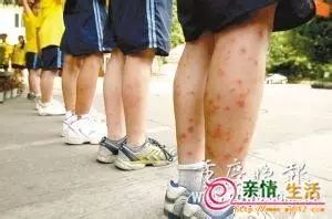韩国研究表明被蚊虫叮咬后涂唾液可致皮肤炎症