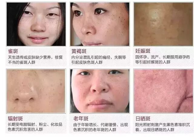 要祛斑，这些色斑面诊原理你要懂！