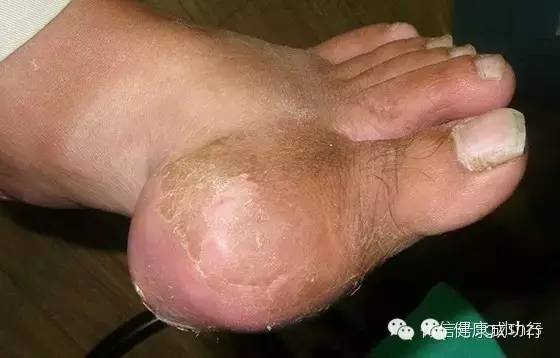 【转载】连中西医都束手无策的痛风,救星居然是这个!! 健康成功行 - ynmzfhl - ynmzfhl的博客 连中西医都束手无策的痛风,救星居然是这个!! 健康成功行 - suay123“阿庆嫂” - 阿庆嫂欢迎来自远方的好友!