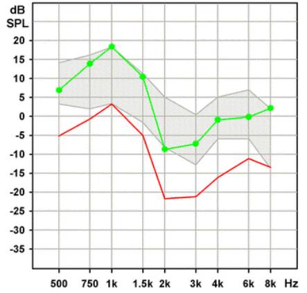 耳声发射图怎么看几种耳声发射的临床类型及特点_https://www.jmylbn.com_新闻资讯_第8张