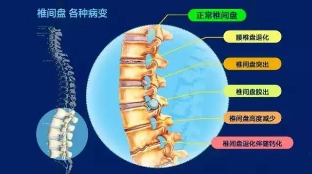 腰椎间盘突出康复锻炼和预防方法(图1)