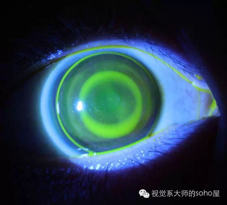 [转载]转载:如何选择角膜塑形镜的品牌