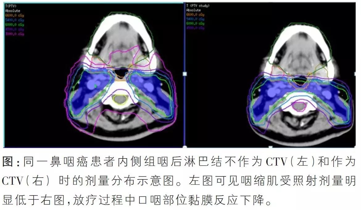 鼻咽癌淋巴结转移的规律以及在精确放疗中的应用