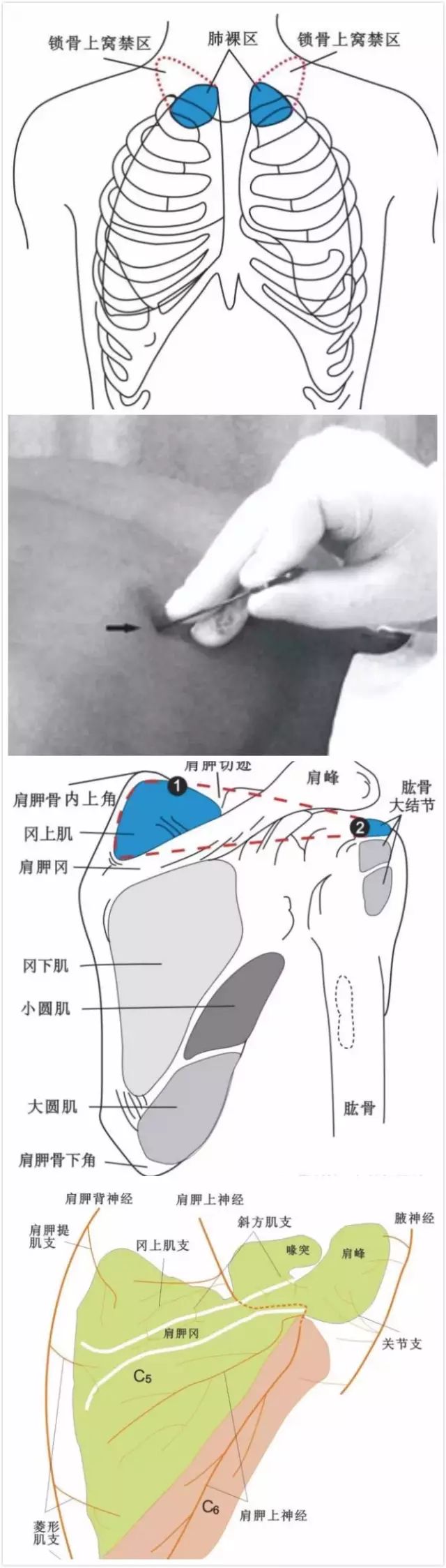 冈上肌损伤微创治疗