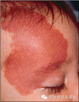 多在出生后2～3周发现,开始仅为红色斑点,4～5个月进人快速生长期,2岁