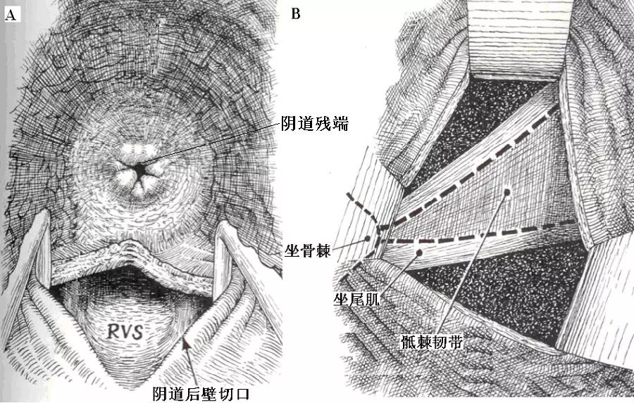 kocher钳是什么中盆腔缺陷的手术治疗--骶棘韧带固定术（三）-上海聚慕医疗器械有限公司