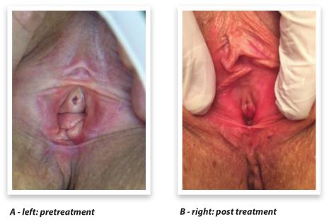 什么是妇科激光Laser CO2（Femilift）菲蜜丽激光在妇科中的应用－－以色列Sheba医疗中心 Menachem Alcalay教授_https://www.jmylbn.com_新闻资讯_第5张