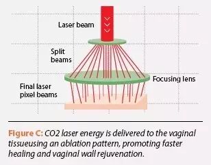 什么是妇科激光Laser CO2（Femilift）菲蜜丽激光在妇科中的应用－－以色列Sheba医疗中心 Menachem Alcalay教授_https://www.jmylbn.com_新闻资讯_第3张