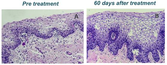 什么是妇科激光Laser CO2（Femilift）菲蜜丽激光在妇科中的应用－－以色列Sheba医疗中心 Menachem Alcalay教授_https://www.jmylbn.com_新闻资讯_第4张