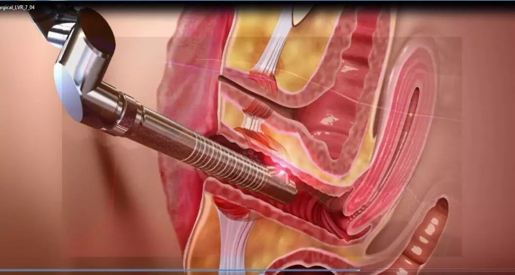 什么是妇科激光Laser CO2（Femilift）菲蜜丽激光在妇科中的应用－－以色列Sheba医疗中心 Menachem Alcalay教授_https://www.jmylbn.com_新闻资讯_第2张