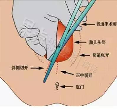 事实上就顺产过程而言,真正需要"切一个口子"来生产的人并不多.