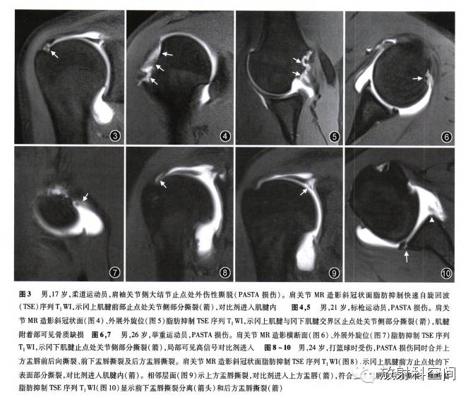 肩关节mr造影诊断肩袖关节侧大结节止点处外伤性撕脱的价值