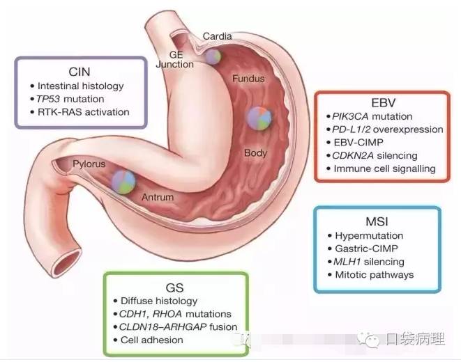 胃癌的分子病理分型
