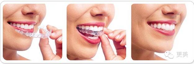 隐适美矫正的疗程还要根据牙齿的具体情况确定,一般要佩戴1~2年.