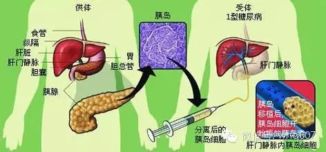 健康管理师科普|乔布斯八年疾病抗争史——胰腺癌