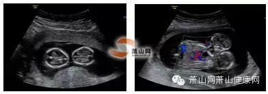 萧山一女士怀孕联体双活胎:两个婴儿胸腹部紧密相连,只有一个肝脏和心脏-怀孕期