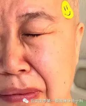 微创开颅手术 彻底治愈八旬老人面肌痉挛