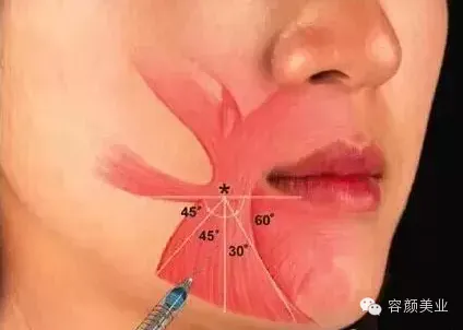 军地医学美容培训笑脸 口角上扬 的肉毒素注射要点 军地微整形培训