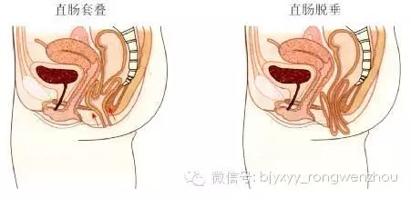 直肠内套叠的发生与排便久蹲用力有关,造成直肠粘膜松弛,脱垂于直肠