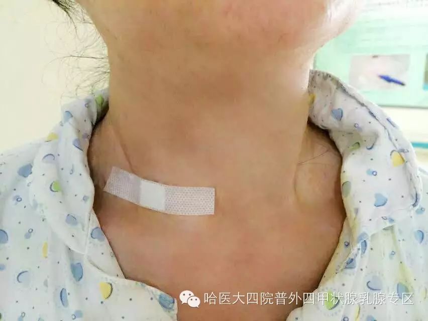 哈医大四院普外四病房--省内率先引进甲状腺射频消融术开启甲状腺超