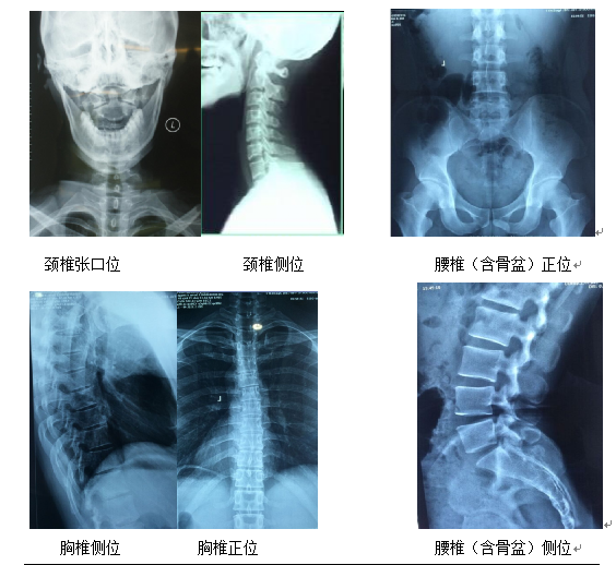 均需要拍摄完整的脊椎图像,包括颈椎张口位,颈椎侧位,胸椎