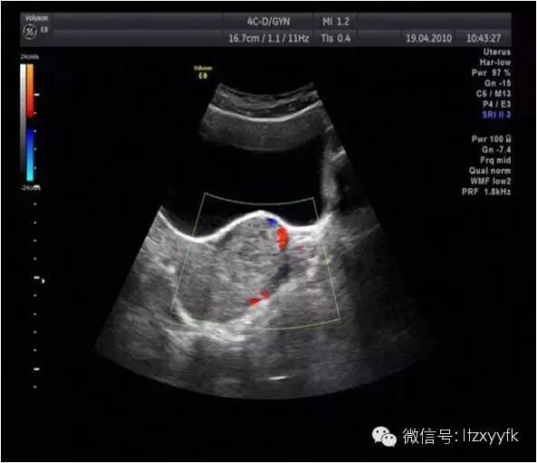 二胎前,你需要了解的事儿–剖宫产瘢痕妊娠-怀孕期
