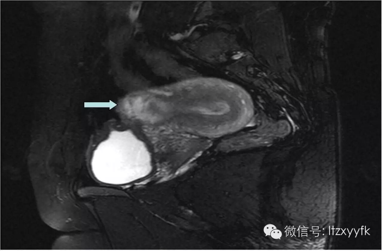 二胎前,你需要了解的事儿–剖宫产瘢痕妊娠-怀孕期