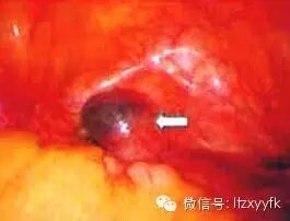 二胎前,你需要了解的事儿–剖宫产瘢痕妊娠-怀孕期