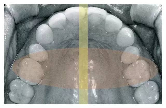 【干货】上颌咬合面的口腔摄影及其要点