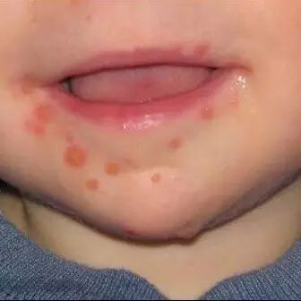 宝宝出疹子你怕不怕？史上最全出疹攻略（推荐收藏）微...