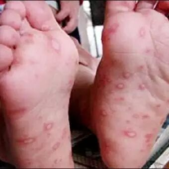 宝宝出疹子你怕不怕？史上最全出疹攻略（推荐收藏）微...