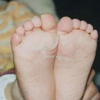 宝宝出疹子你怕不怕？史上最全出疹攻略（推荐收藏）微...