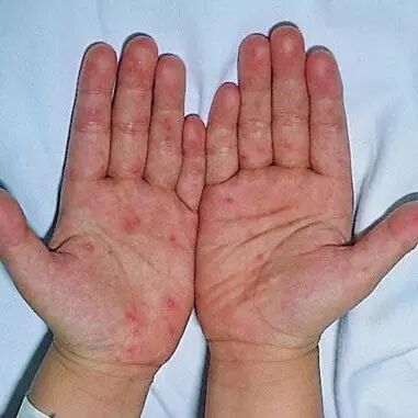 宝宝出疹子你怕不怕？史上最全出疹攻略（推荐收藏）微...