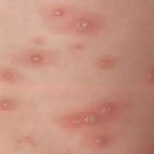 宝宝发烧与皮肤出疹子的关系 教你鉴别各类型皮疹