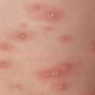 宝宝出疹子你怕不怕？史上最全出疹攻略（推荐收藏）微...