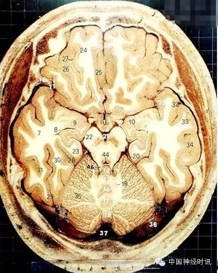 又认贷"该不该取消1,第三脑室 2,视束 3,灰结节 4,乳头体 5,大脑纵裂