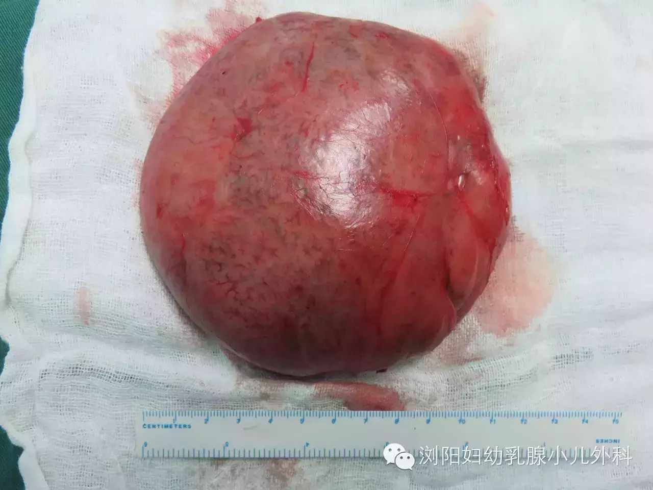 青青右侧乳房切下的巨大肿瘤,最大直径达13cm.