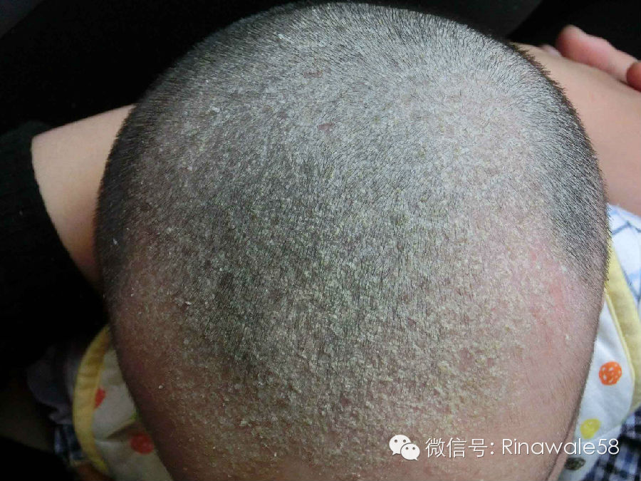 使用原理:  头皮屑的主要原因,是由于真菌感染,导致头部角质层干燥