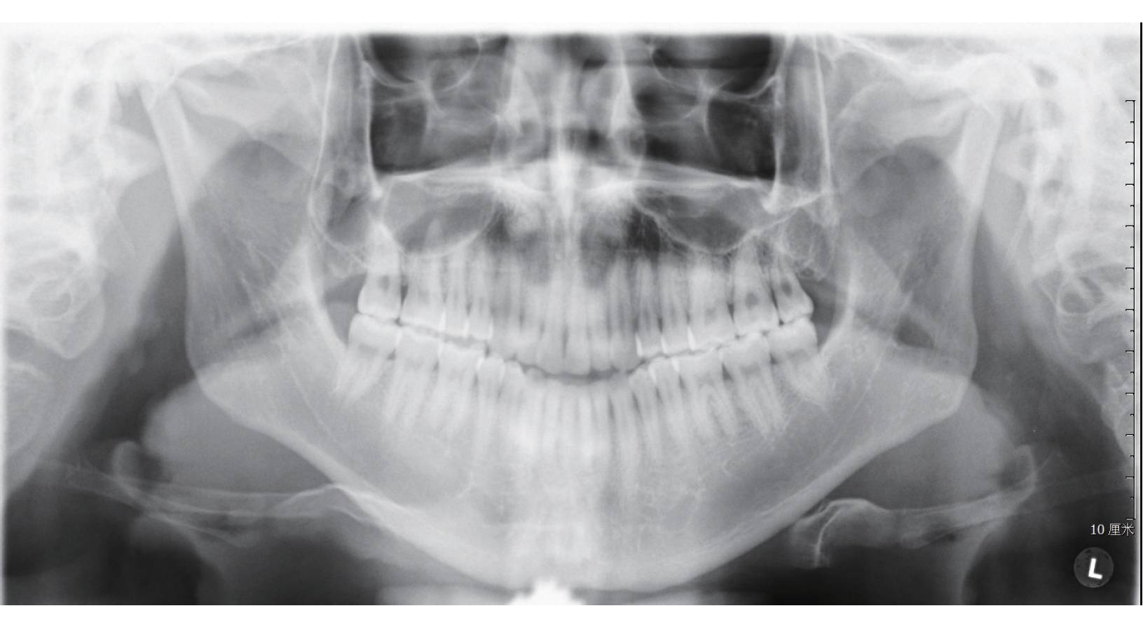 surgery early正畸正颌联合治疗模式