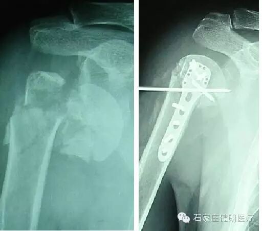 悬吊训练系统在临床上的运用(图8)