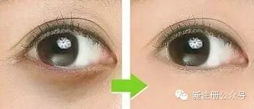 眼部干纹怎么办 金泰熙去黑眼圈方法 如何消除黑眼圈么 眼...