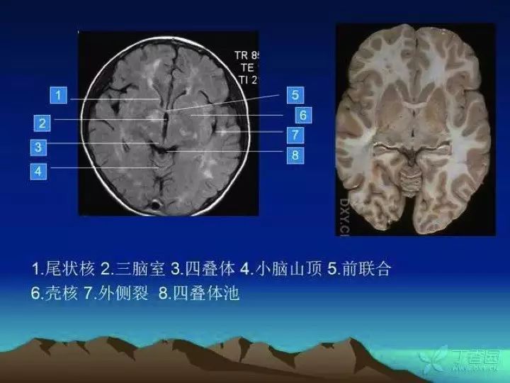 入门必备:头颅 mri 断层解剖