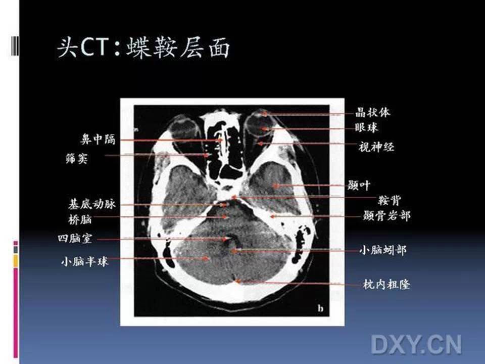 10张图搞定正常头颅ct断层解剖