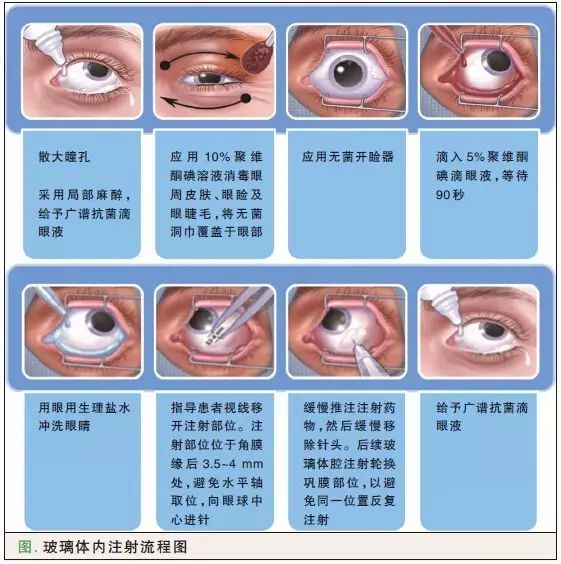 moorfields眼科医院玻璃体腔注药指南